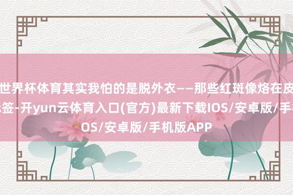 世界杯体育其实我怕的是脱外衣——那些红斑像烙在皮肤上的标签-开yun云体育入口(官方)最新下载IOS/安卓版/手机版APP